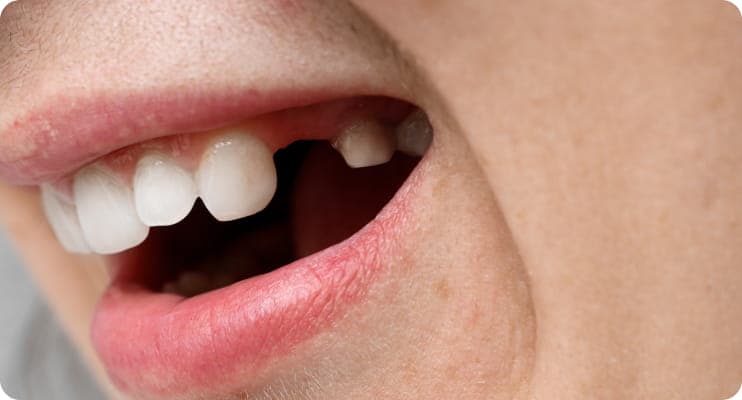 Nedostaje jedan zub u gornjoj vilici praznina između zdravih zuba