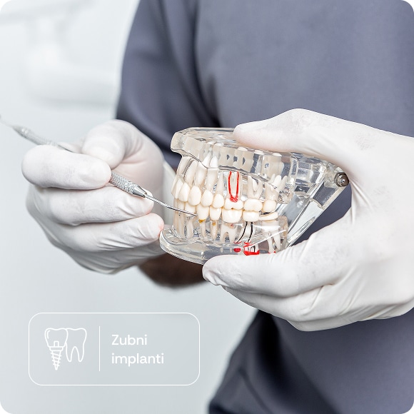 Prikaz zubnih implantata na stomatološkom modelu tokom konsultacije