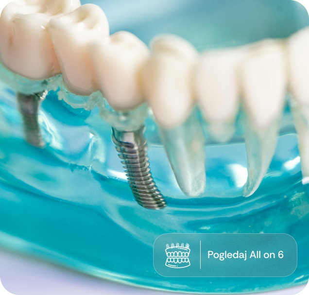 All on 6 zubni implanti sa fiksnim mostom u vilici