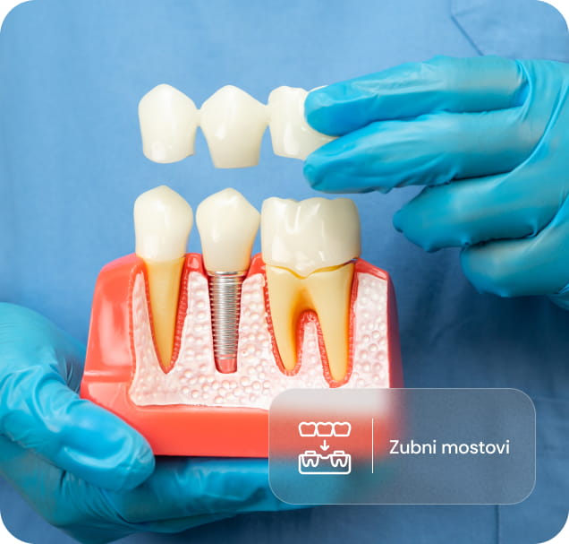 Model zubnog mosta na dentalnom modelu koji prikazuje kako se most postavlja na nosače zuba