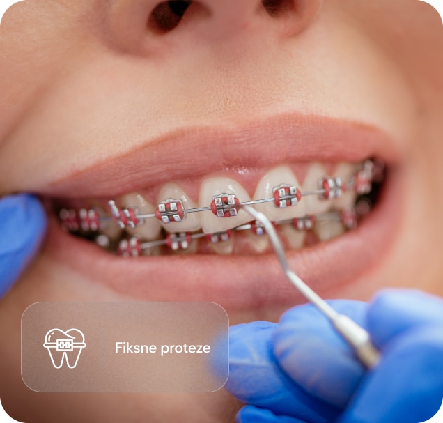 Fiksna proteza na zubima tokom stomatološkog pregleda
