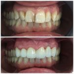 zubi pre i posle izbeljivanja
