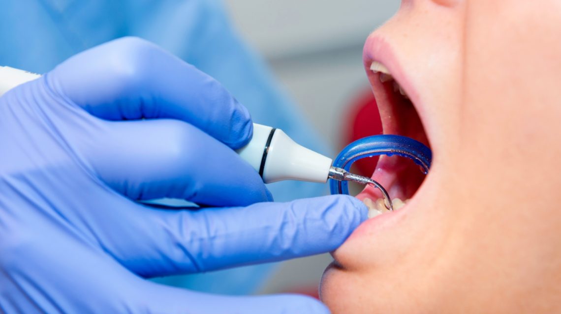 procedura uklanjanja zubnog kamenca