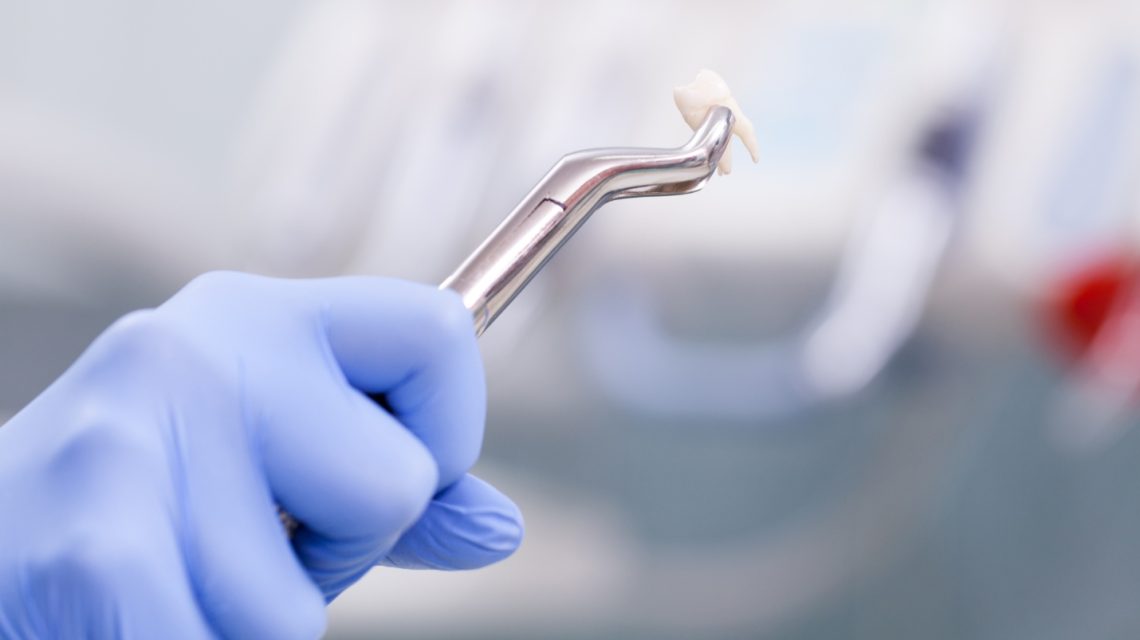 stomatolog drzi klestima izvadjen zub